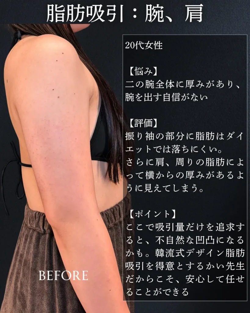 脂肪吸引(二の腕・肩)(加藤快世)