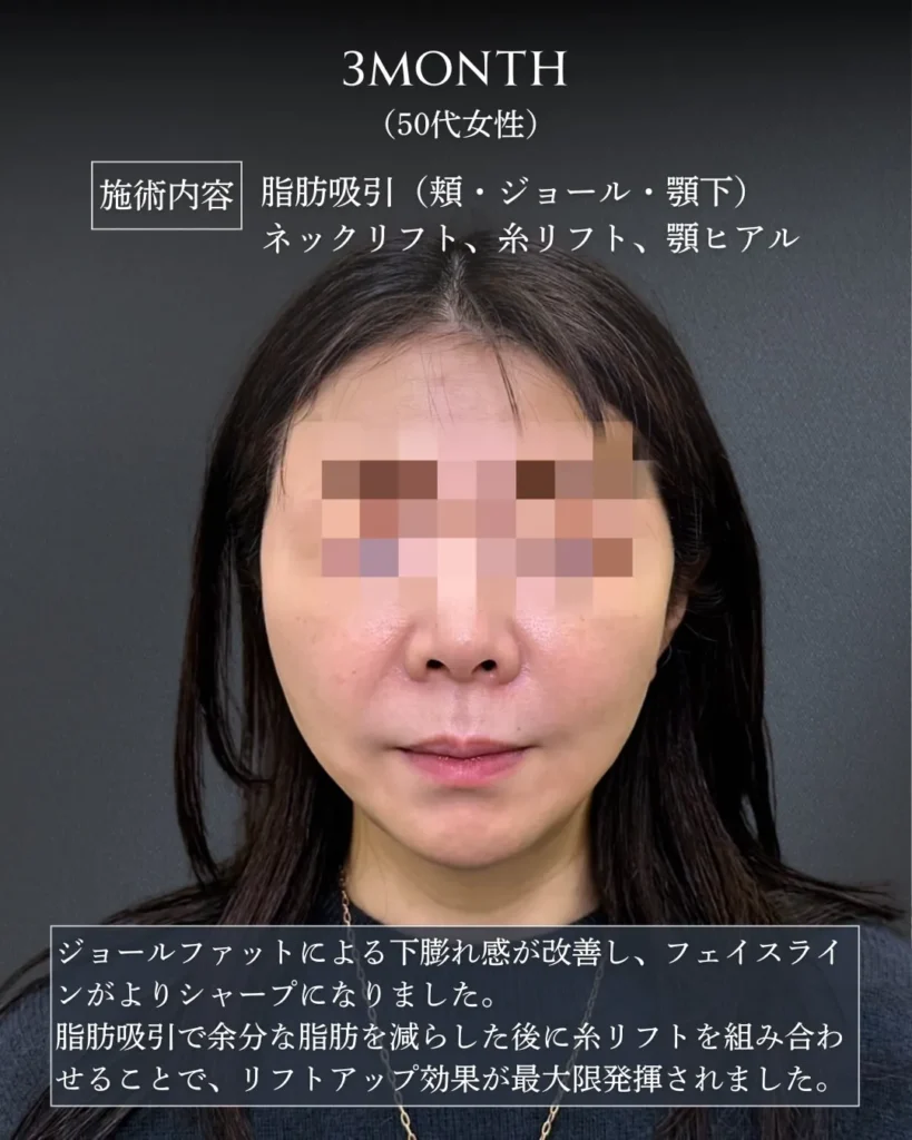 脂肪吸引(頬・ジョールファット・顎下)+ネックリフト+ヒアルロン酸(顎)(加藤快世)