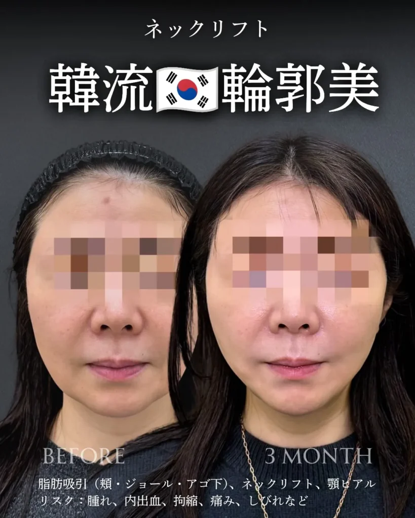 脂肪吸引(頬・ジョールファット・顎下)+ネックリフト+ヒアルロン酸(顎)(加藤快世)