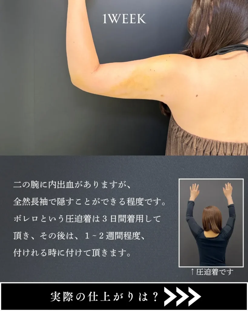 脂肪吸引(二の腕)(加藤快世)