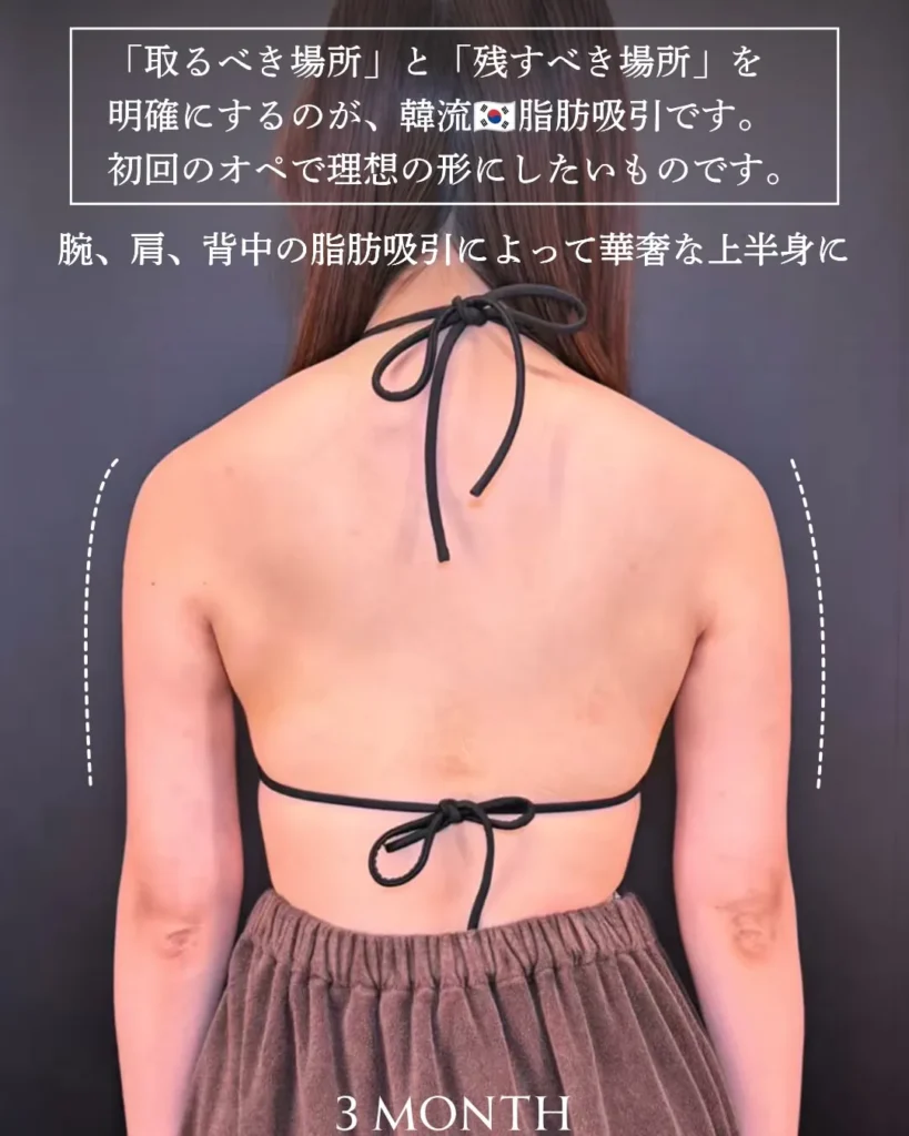 脂肪吸引(二の腕)(他院修正)(加藤快世)