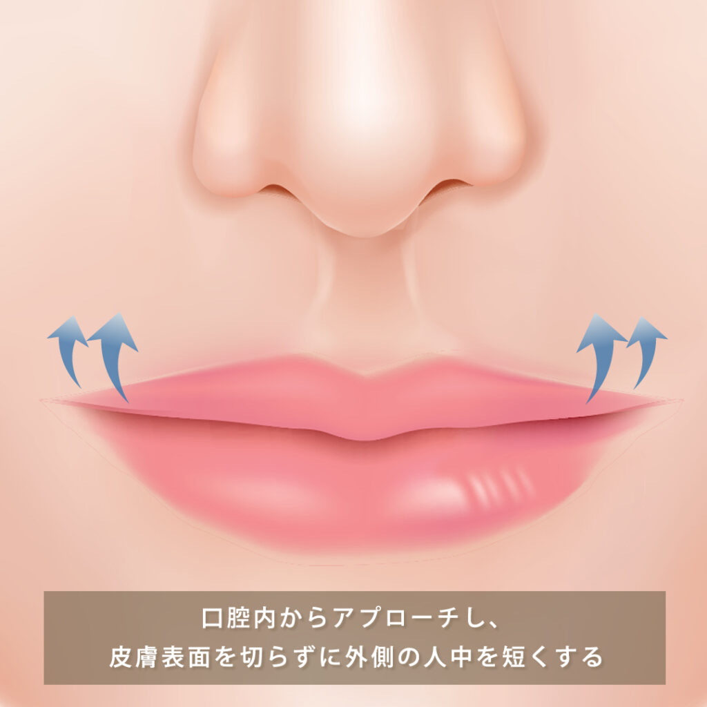 切らない外側人中短縮手術（粘膜切開法）の図解
