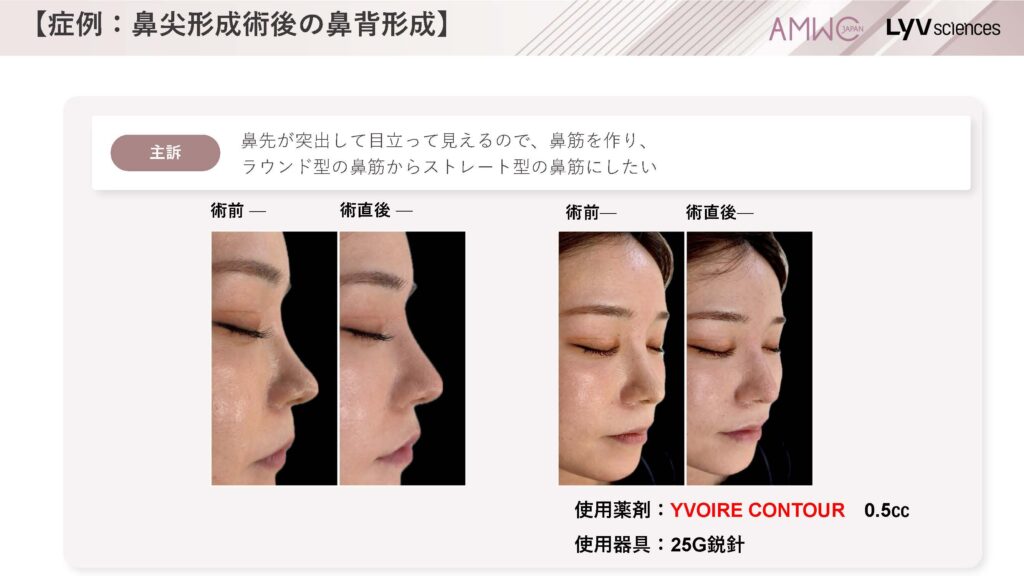 24_症例：鼻尖形成術後の鼻背形成